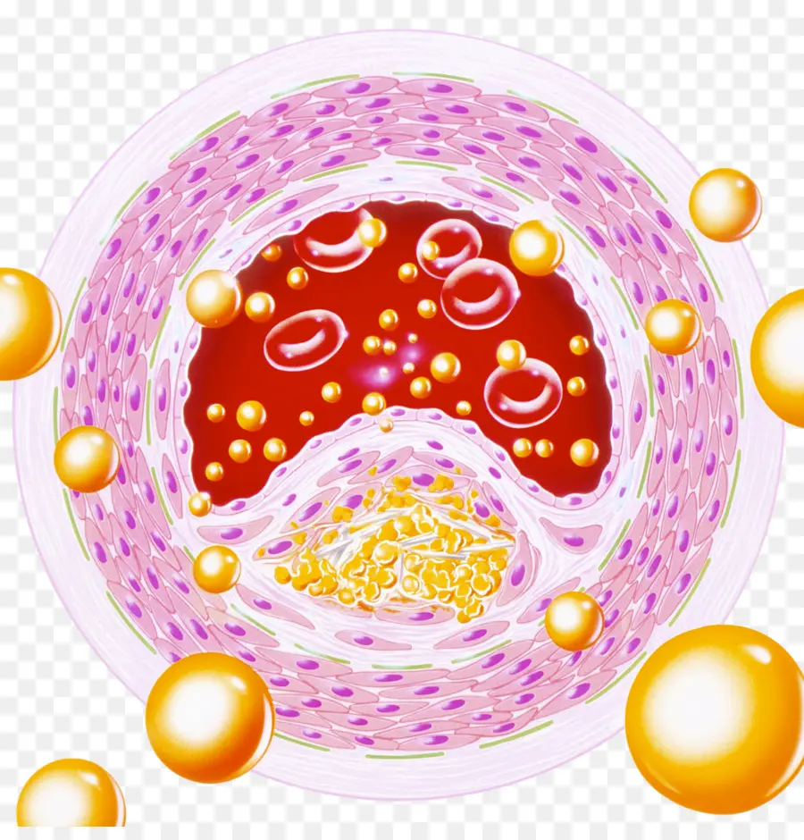 La Arteriosclerosis，De Los Vasos Sanguíneos PNG