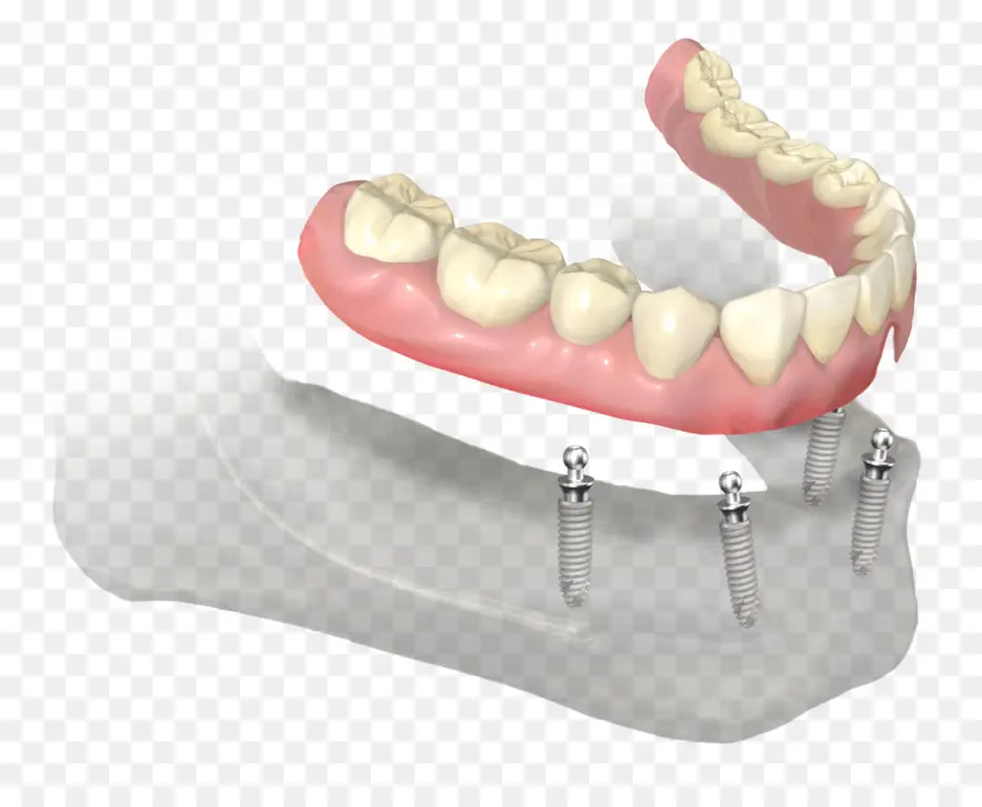 Implantes Dentales，Dientes PNG