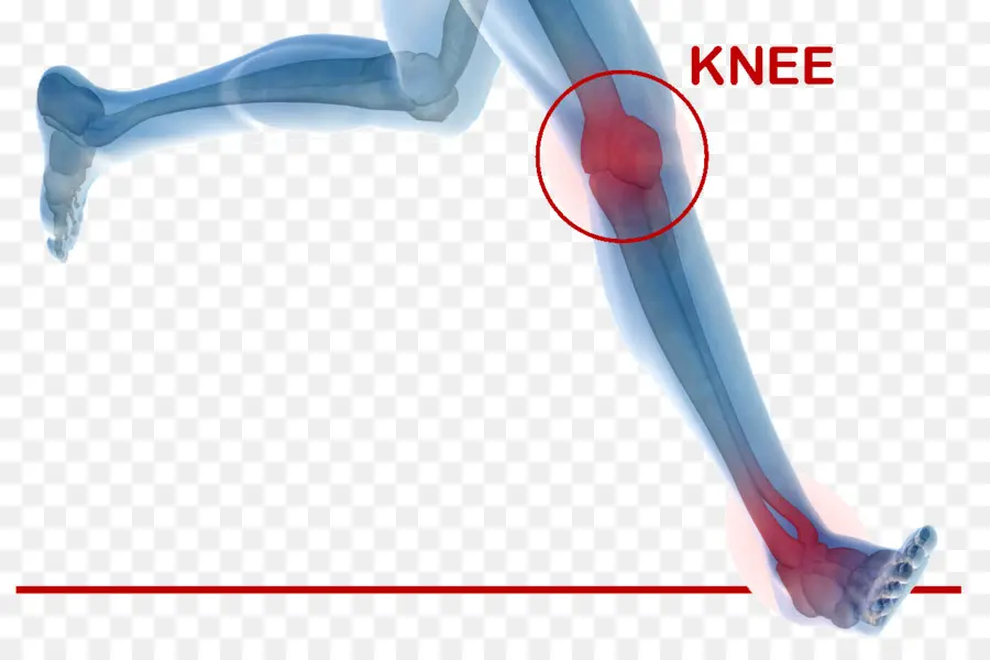 Cirugía Ortopédica，El Reemplazo De Rodilla PNG