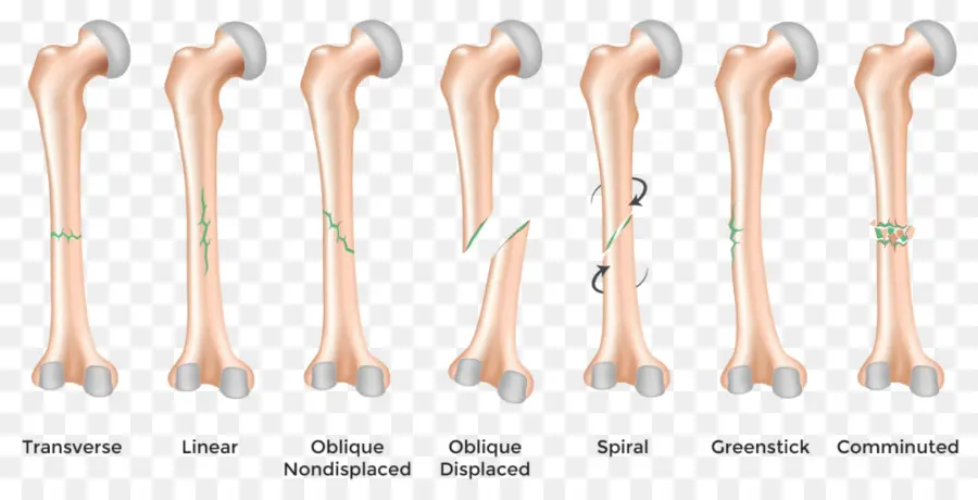 Fracturas óseas，Romper PNG