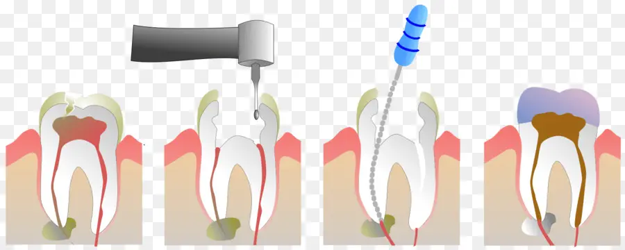 Terapia Endodóntica，La Pulpa PNG