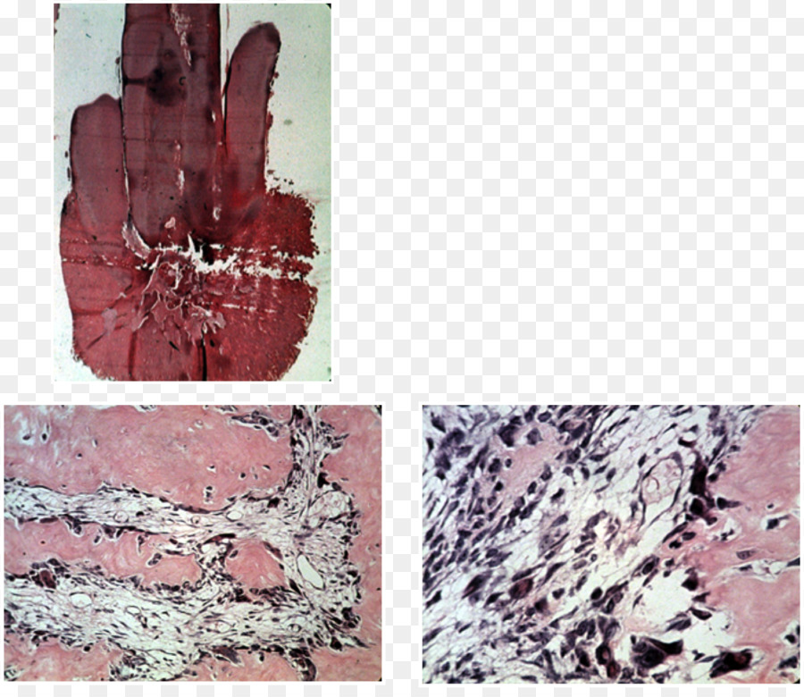 El Ameloblastoma，Tumor Odontogénico PNG