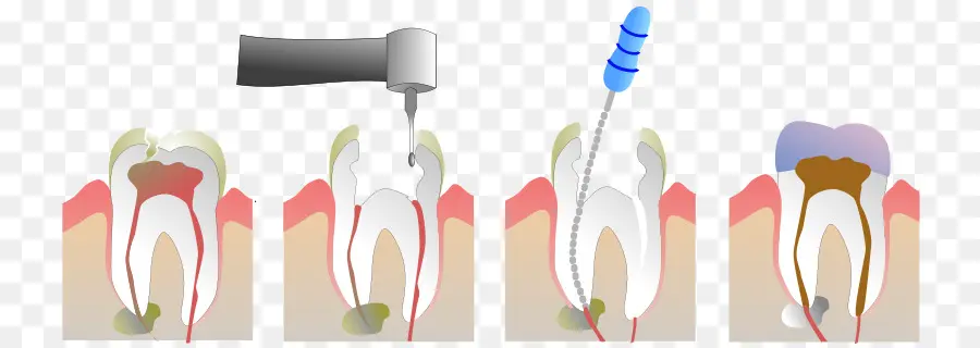 Tratamiento De Conducto，Odontología PNG