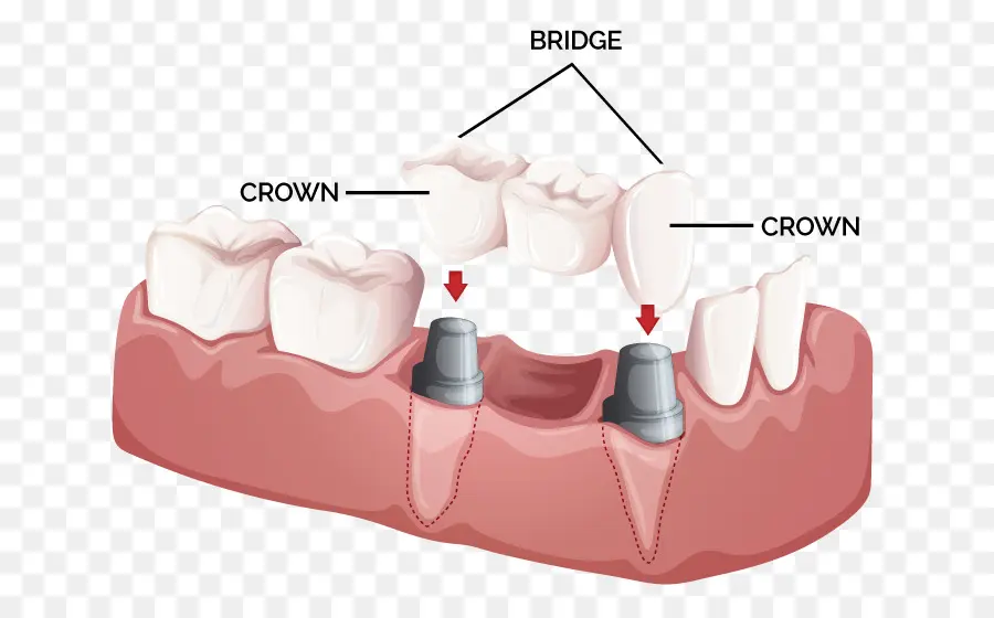 Puente，Corona PNG