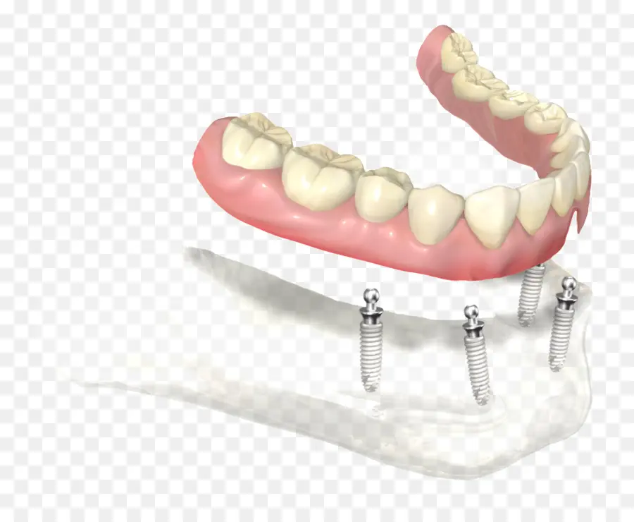 Las Dentaduras Postizas，Implante Dental PNG