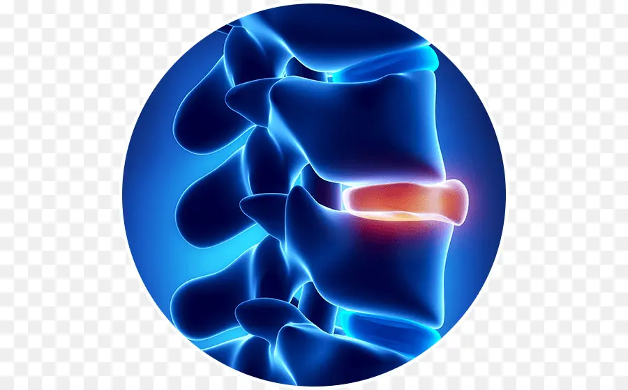 Espinal Hernia De Disco，La Columna Vertebral PNG