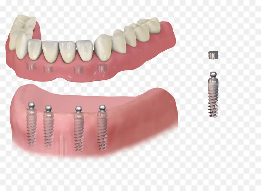 Implante Dental，Odontología PNG