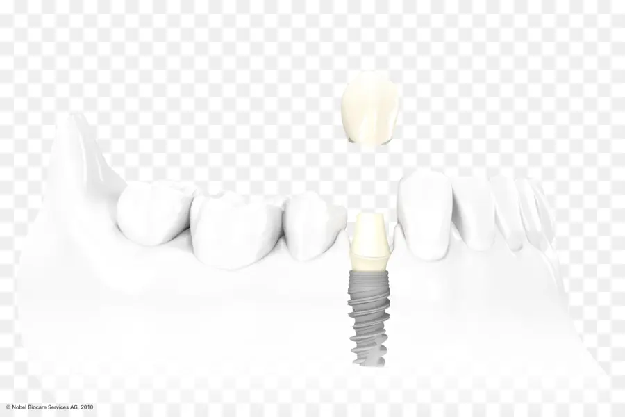 Implante Dental，Odontología PNG