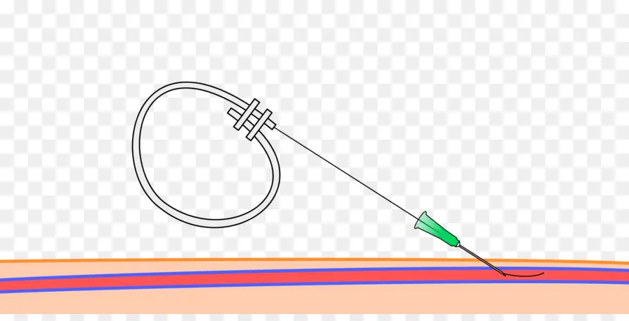 La Técnica De Seldinger，Catéter PNG