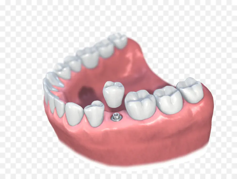 Implante Dental，Dentista PNG