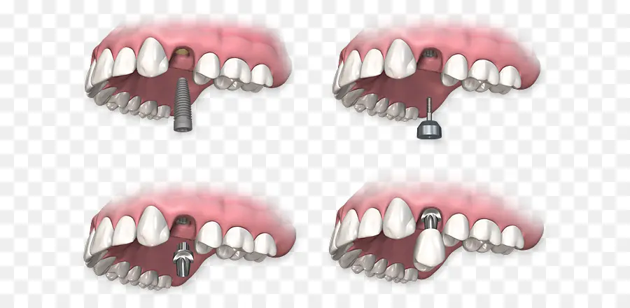 Implantes Dentales，Dientes PNG