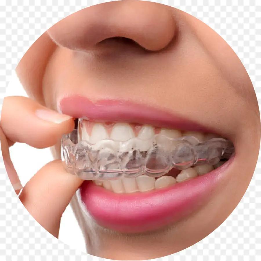 Alineador De Dientes，Dental PNG