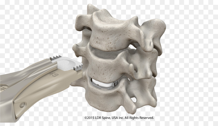 Disco Intervertebral De La Artroplastia De，La Discectomía Cervical Anterior Y Fusión PNG