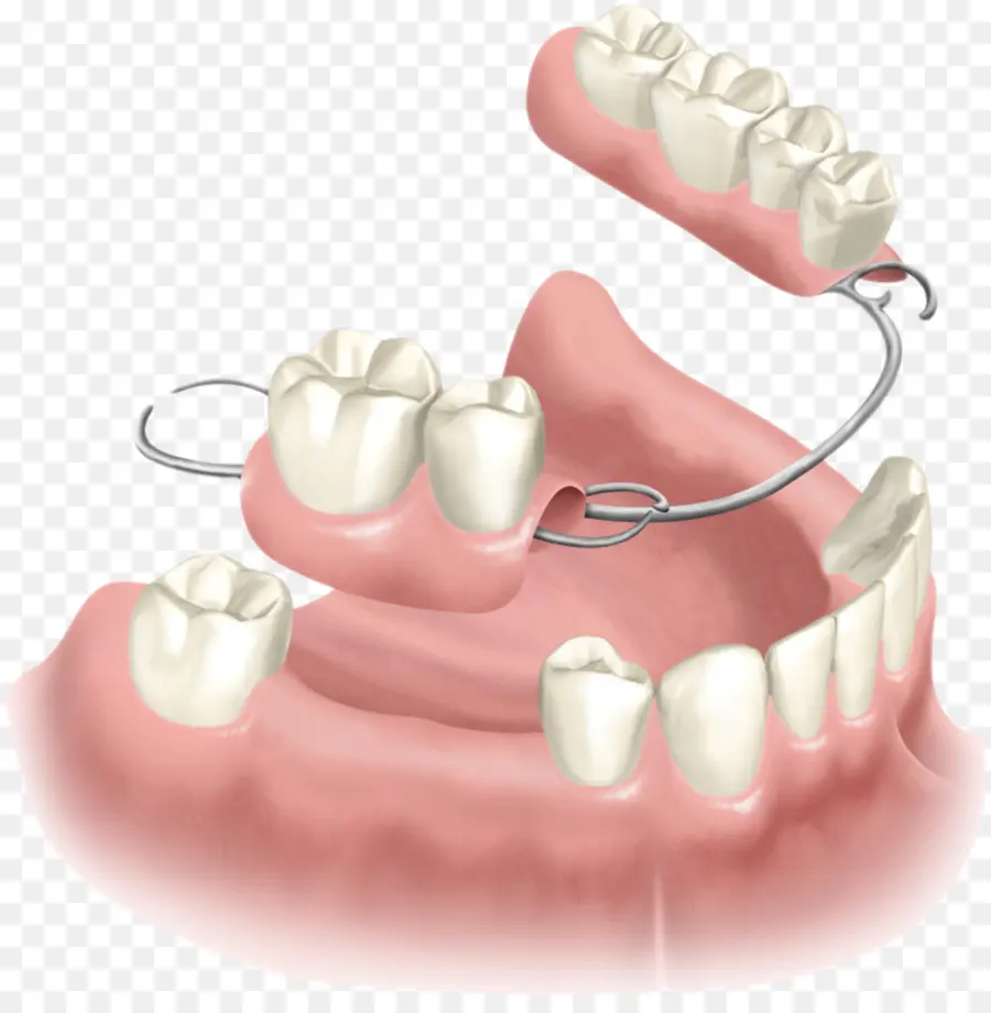 Prótesis Parcial Removible，Las Dentaduras Postizas PNG