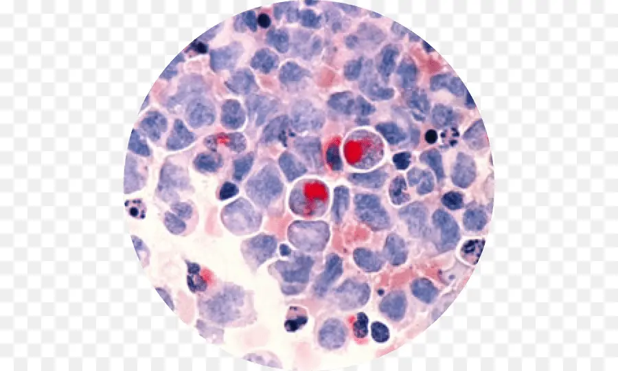 La Leucemia Mieloide Aguda，La Leucemia PNG