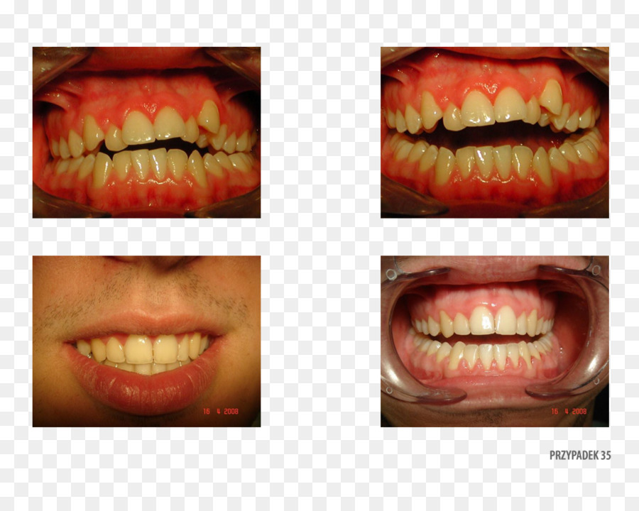 Diente，Gingivoplastia PNG