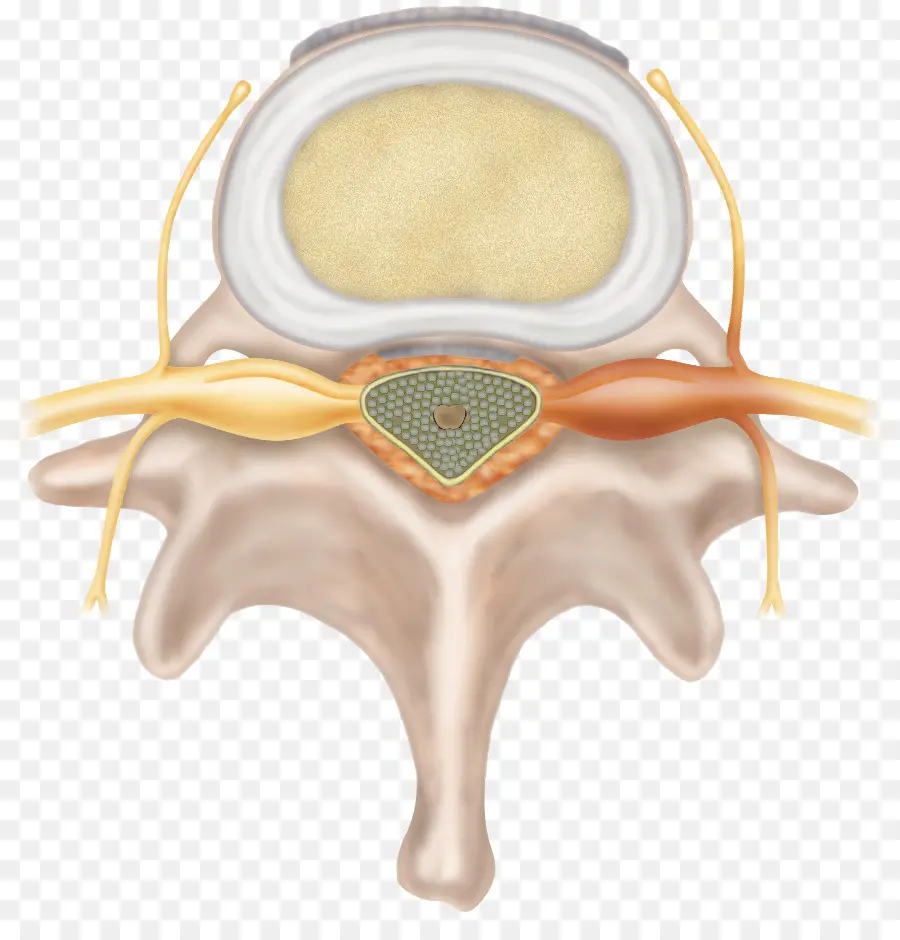 Espinal Hernia De Disco，Disco Intervertebral PNG