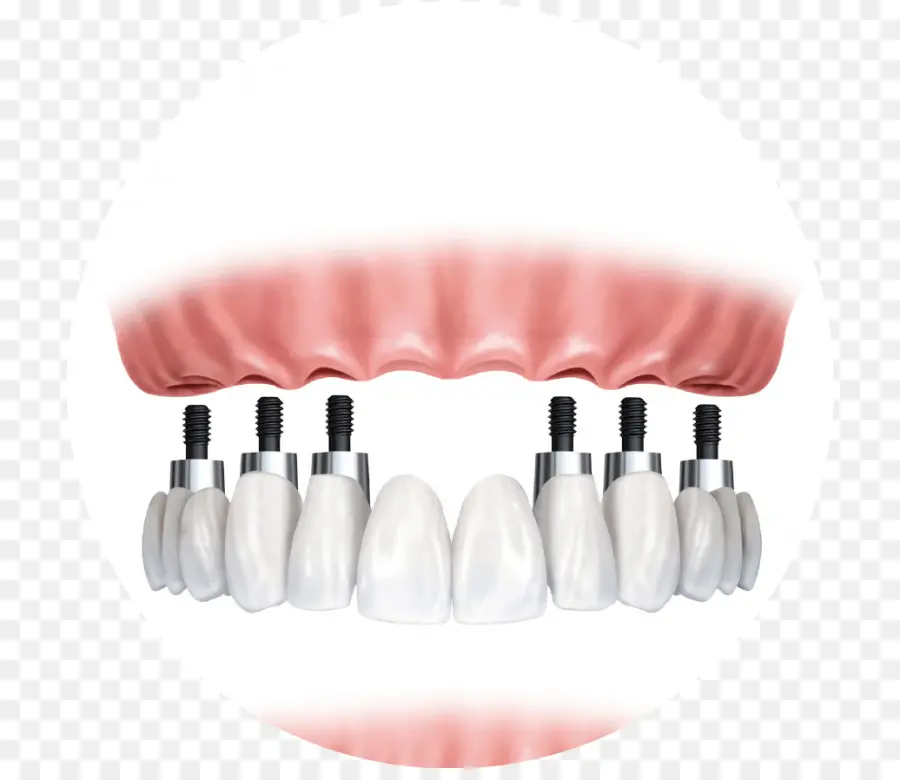 Implantes Dentales，Dientes PNG