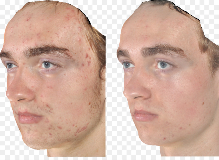 Benzoyl Peroxide，El Acné PNG