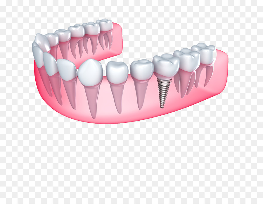 Implante Dental，Odontología PNG