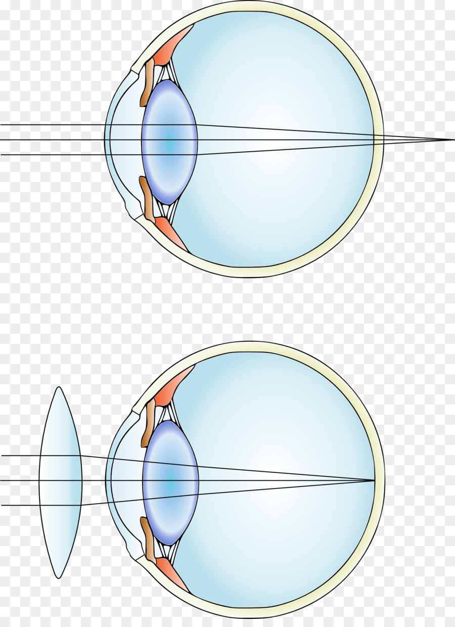 La Miopía，La Lente Correctiva PNG