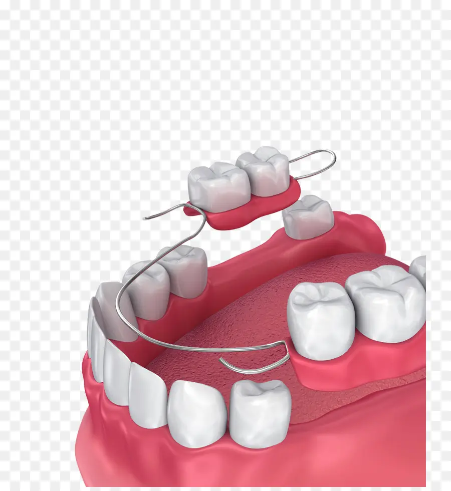 Prótesis Parcial Removible，Las Dentaduras Postizas PNG