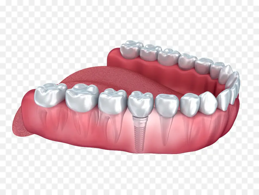 Implante Dental，Diente Humano PNG