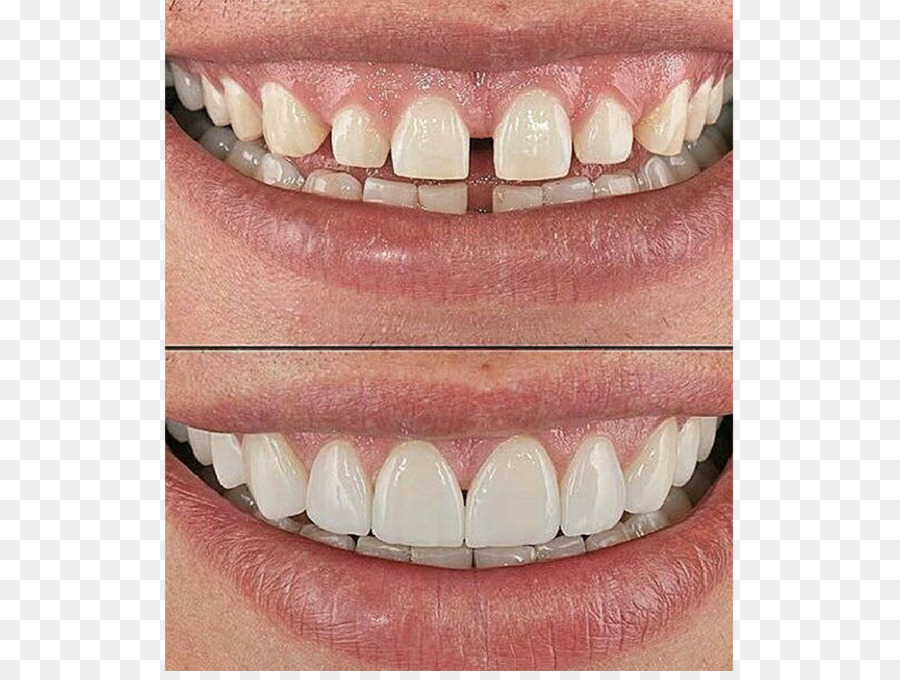 Dientes，Antes PNG