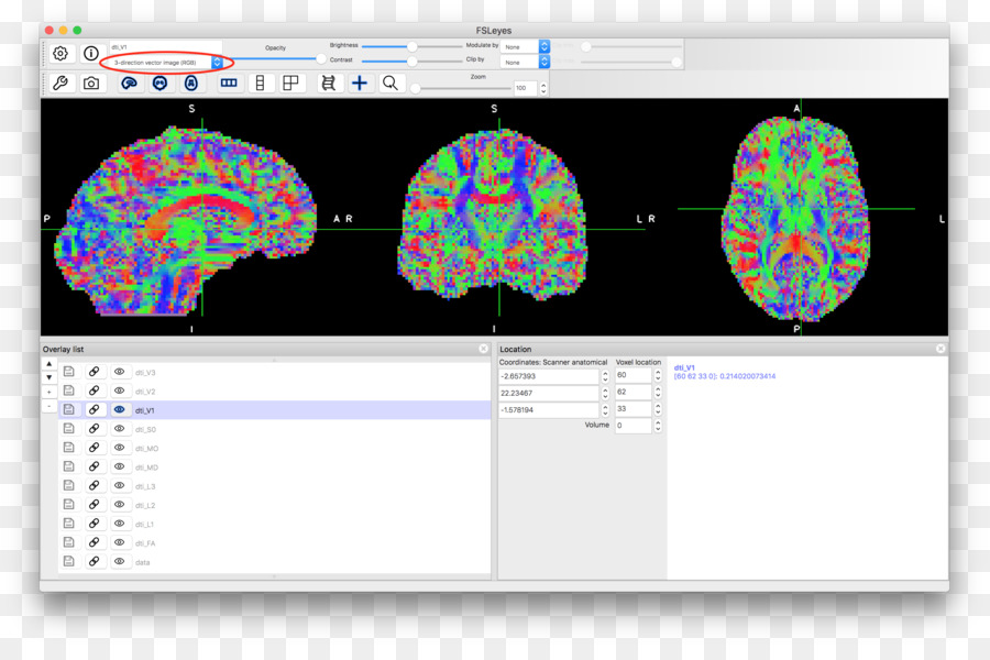 La Difusión Mri，Escalar PNG