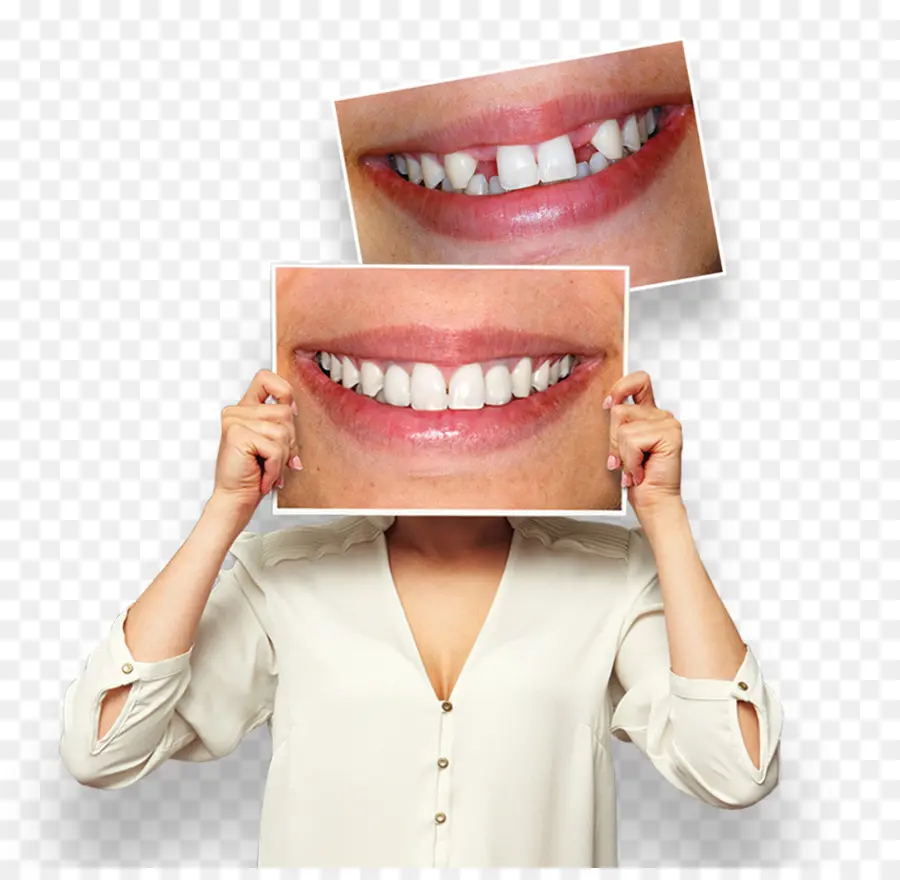 Sonrisa，El Blanqueamiento De Dientes PNG