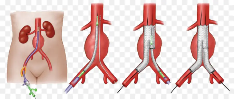 Aneurisma Aórtico Abdominal，Reparación Del Aneurisma Endovascular PNG