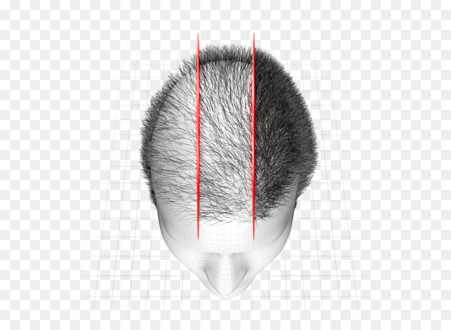 Hair Loss，Hair PNG