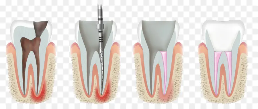 Terapia Endodóntica，Endodoncia PNG