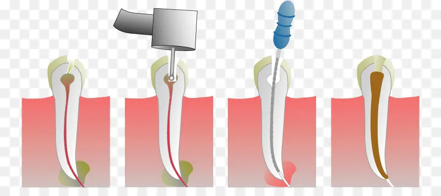 Terapia Endodóntica，El Canal De La Raíz PNG