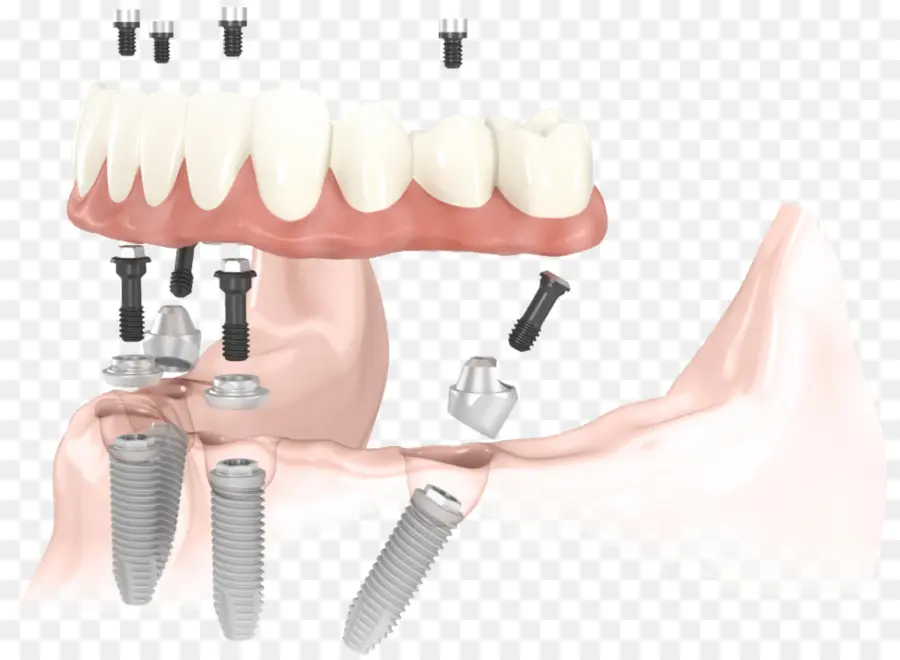 Implantes Dentales，Dientes PNG