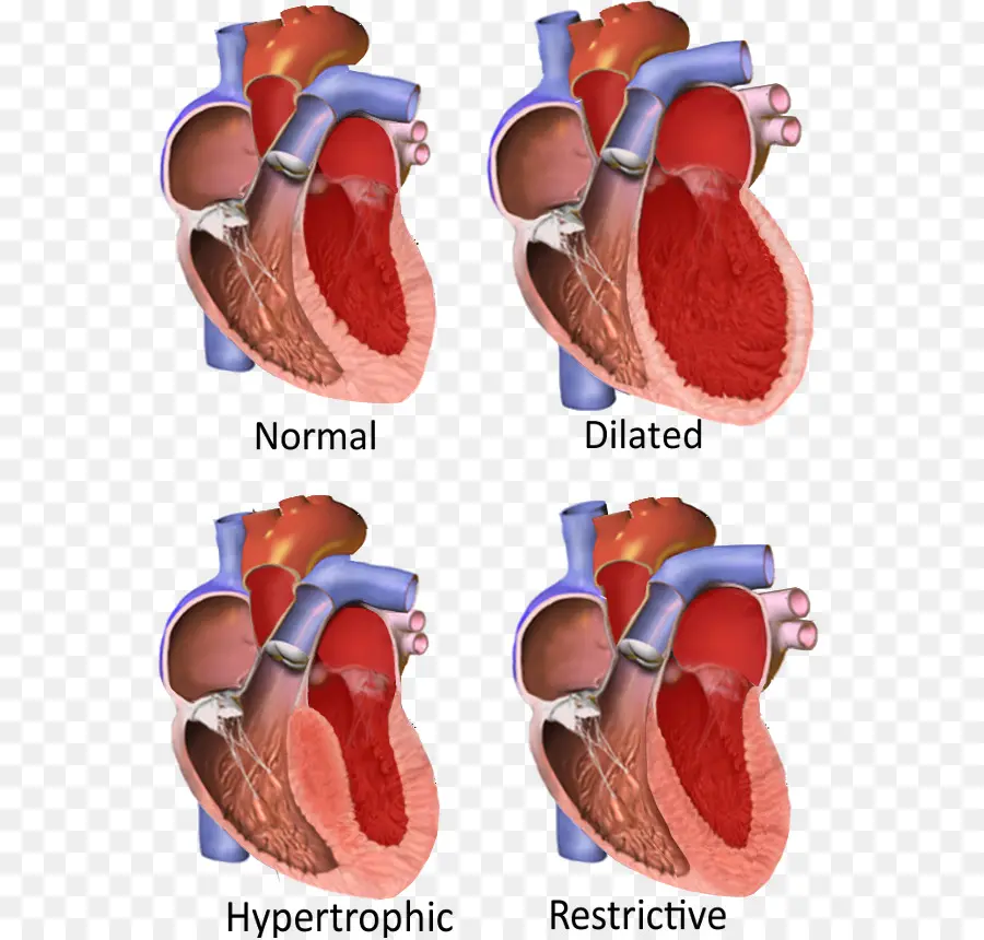 Miocardia，Miocardiopatía Restrictiva PNG