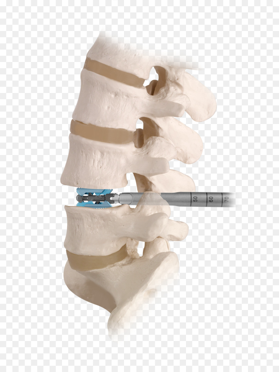 La Fusión Espinal，La Columna Vertebral PNG