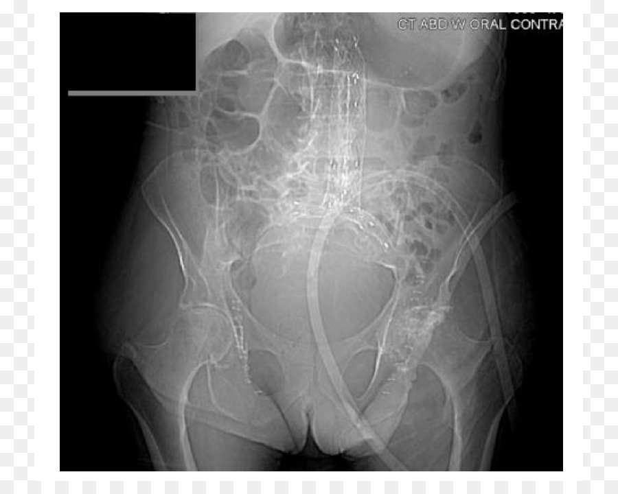 Abdominal Aneurysm Aórtico，Endovascular Aneurysm Repair PNG