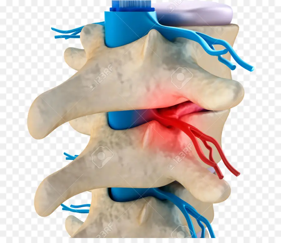 La Columna Vertebral，Subluxación Vertebral PNG