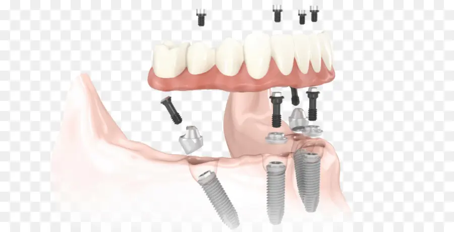 Allon4，Implante Dental PNG