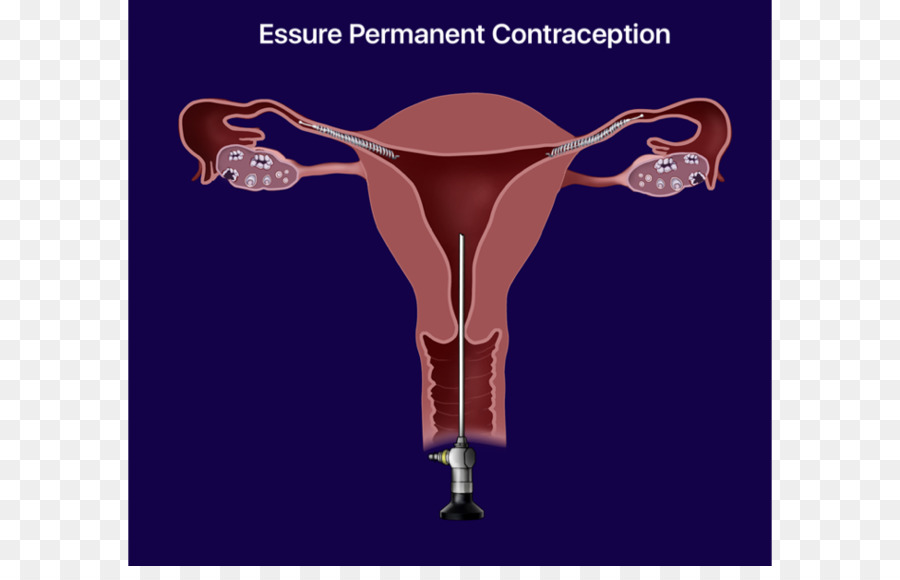 Essure，El Control De La Natalidad PNG