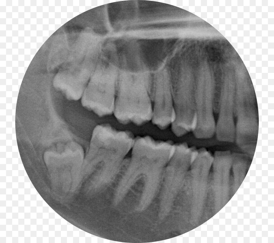 La Muela Del Juicio，Extracción Dental PNG