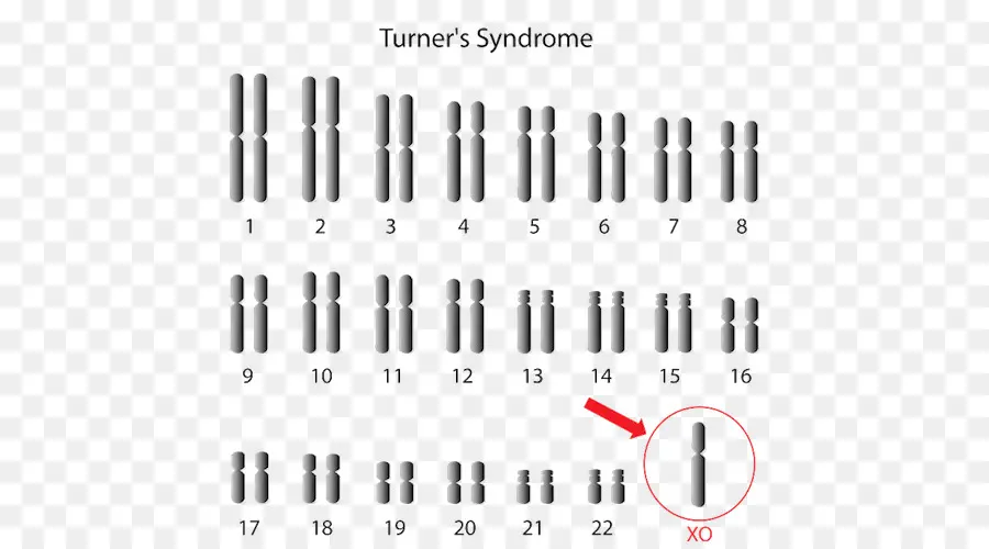 Monosomía，El Síndrome De Turner PNG