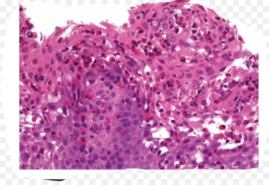 La Esofagitis Eosinofílica，La Esofagitis PNG