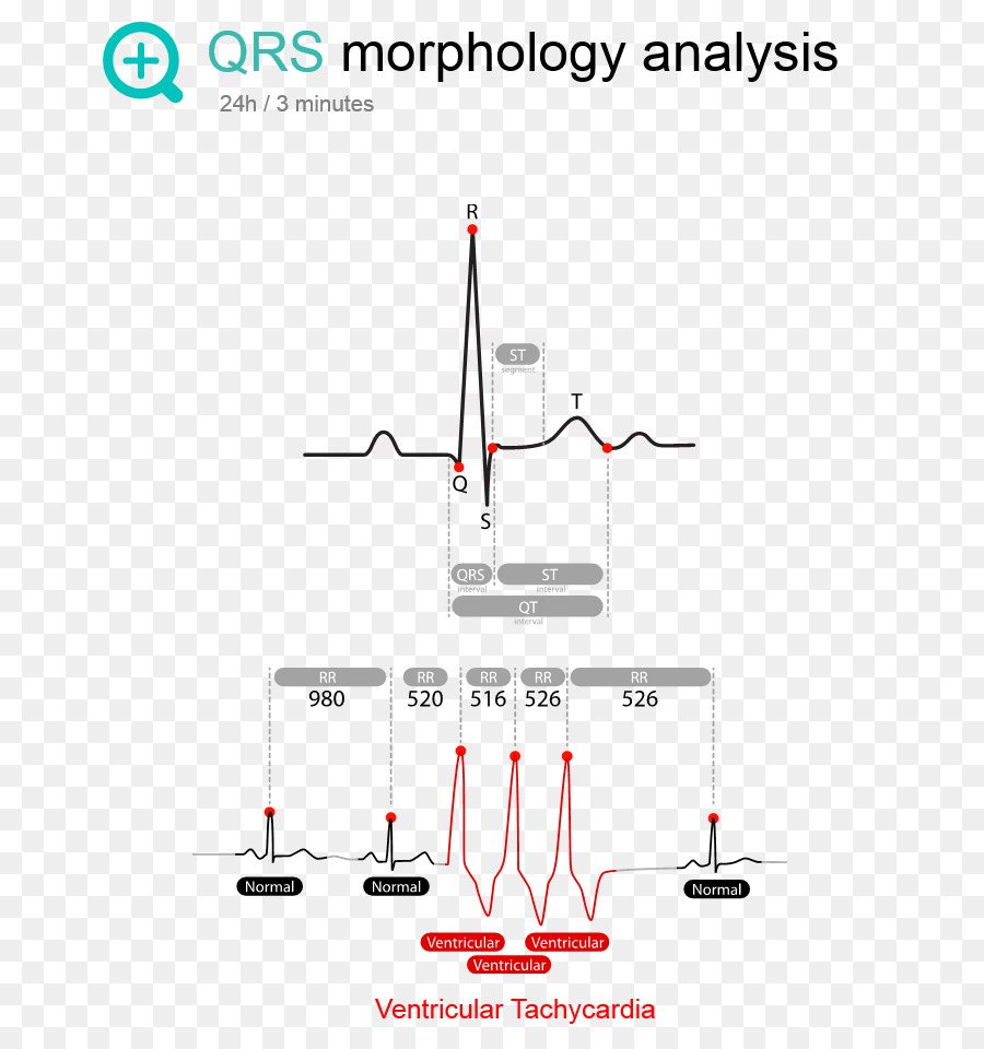 Análisis De La Morfología Del Qrs，Ecg PNG