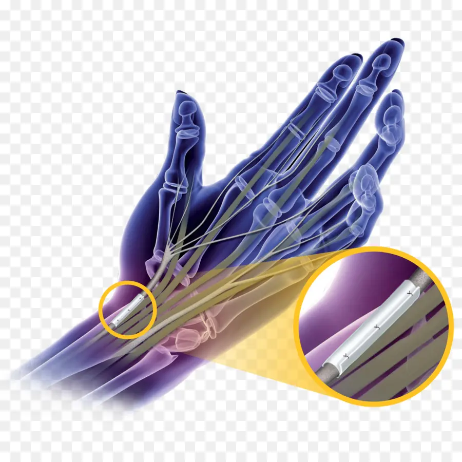 El Síndrome Del Túnel Carpiano，La Cirugía PNG