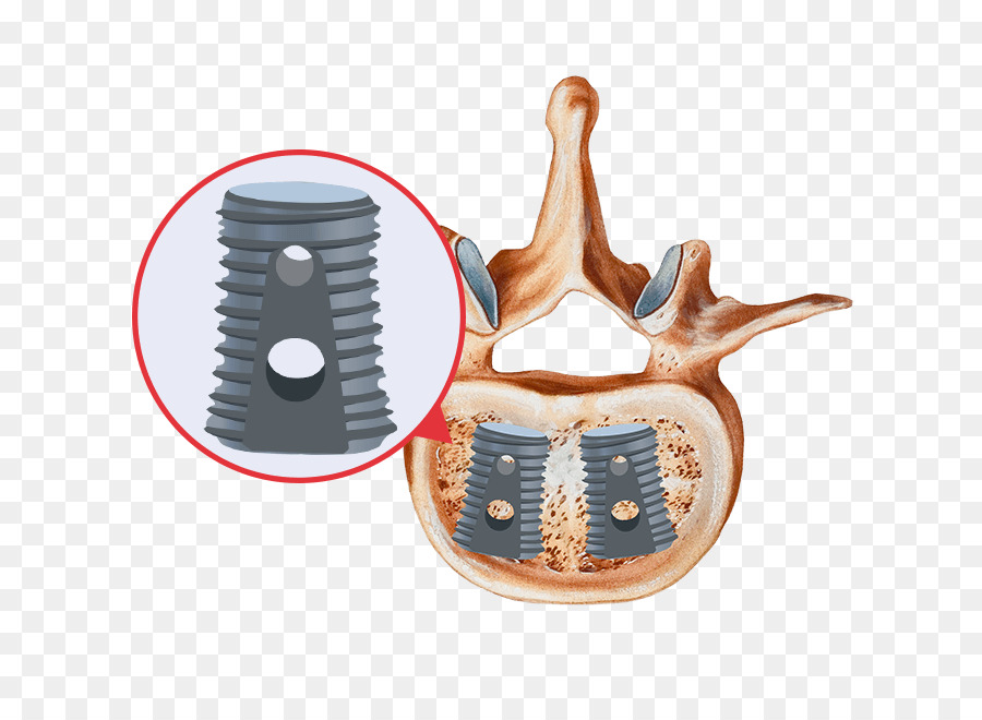Injerto De Hueso，La Fusión Espinal PNG