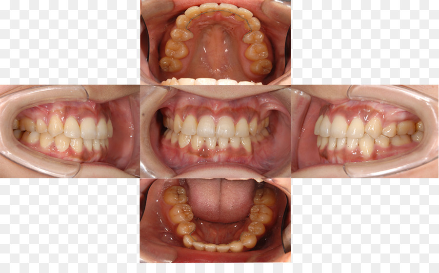 Diente，La Enfermedad Periodontal PNG