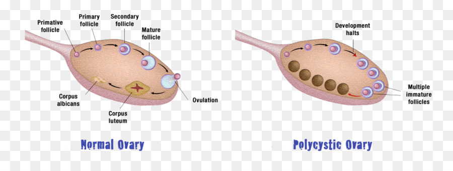 El Síndrome De Ovario Poliquístico，Ovario PNG