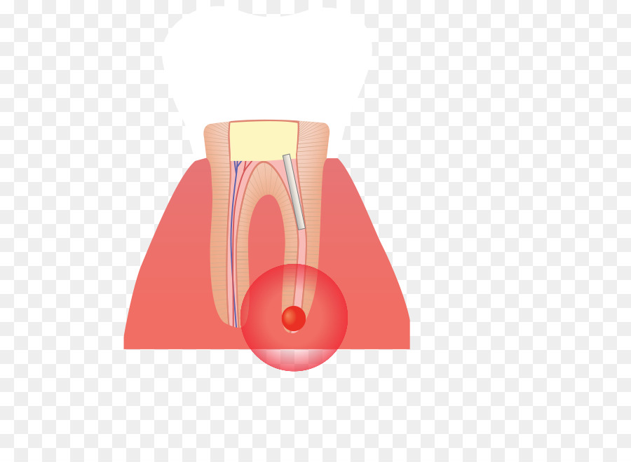 Canal Raíz，Infección PNG